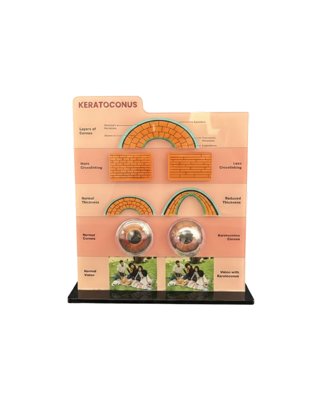 Keratoconus_Counselling_Tool