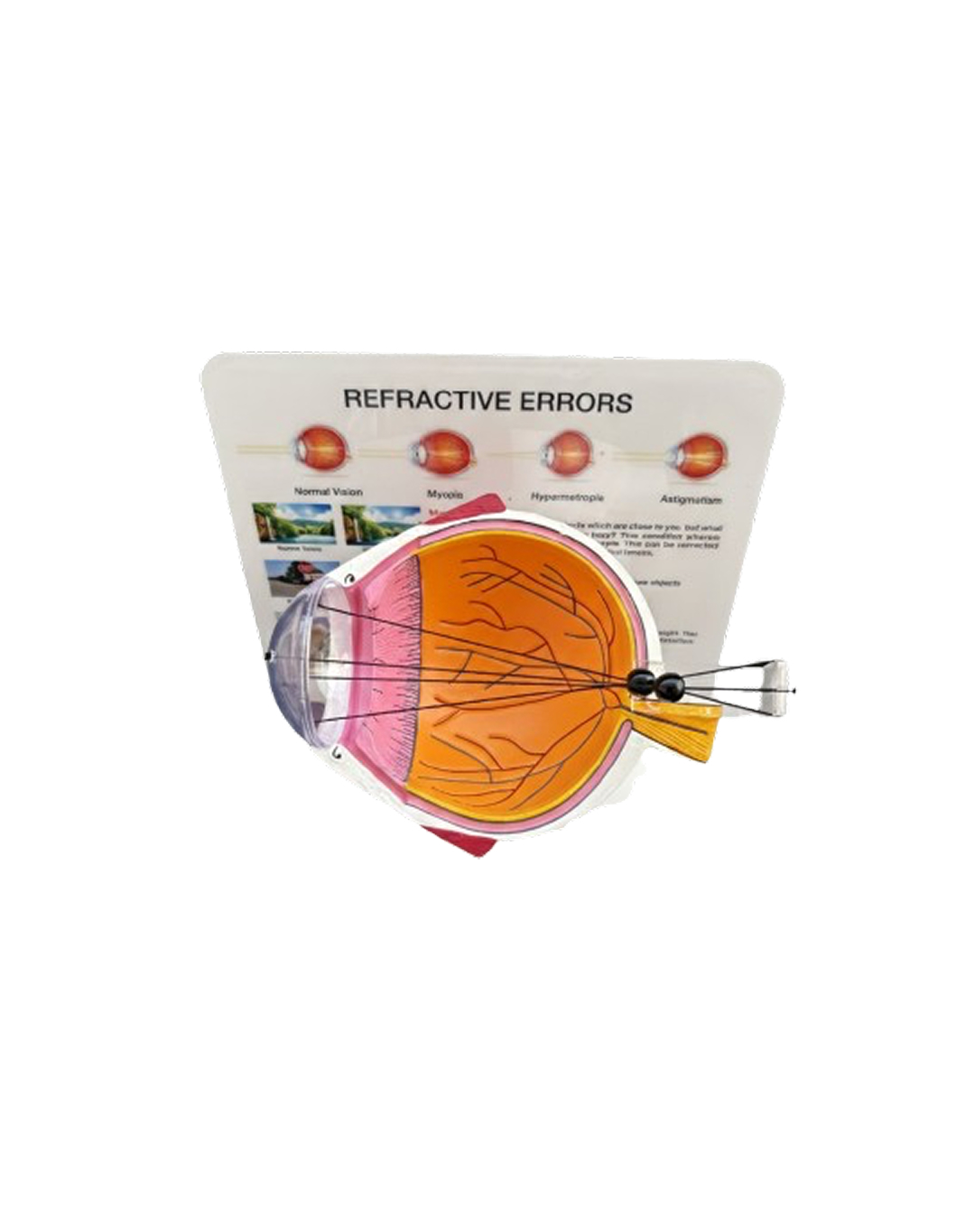 Refractive_Errors_Eye_Model1